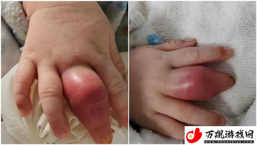 宝宝仅三根手指却如此疼痛令人揪心